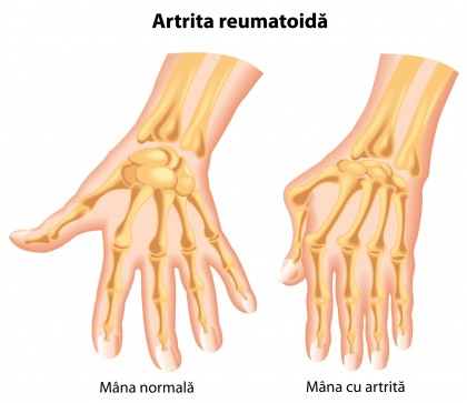 Lumina infraroșie - o nouă metodă de diagnosticare a artritei reumatoide