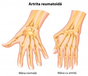 degetele cu artrita reumatoidă)