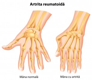 boli articulare strâmbate