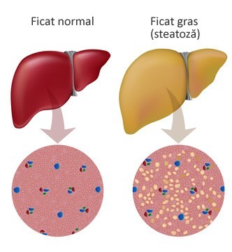 Steatoza hepatica - Ficatul gras