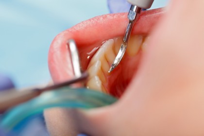 Prevenirea apariției cariilor dentare folosind nanoparticule de ceriu