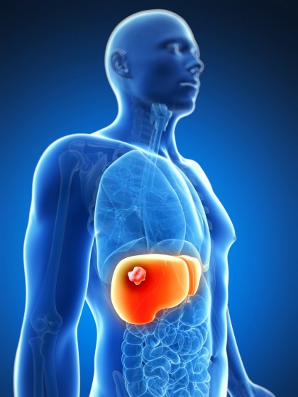 Abcese hepatice