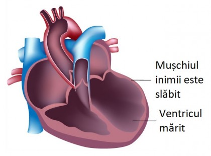 Dilatarea atriilor sau a ventriculelor - explicații cauze, riscuri