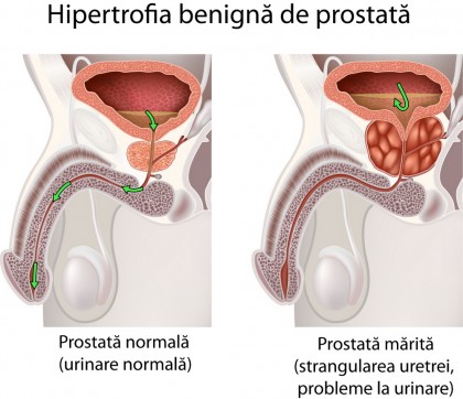 hipertrofie prostatica benigna ce inseamna)