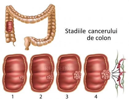 Screening-ul pentru cancerul colo-rectal, recomandat de la 45 de ani, în loc de 50 ani, cum prevăd ghidurile actuale