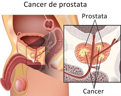 prostata boala