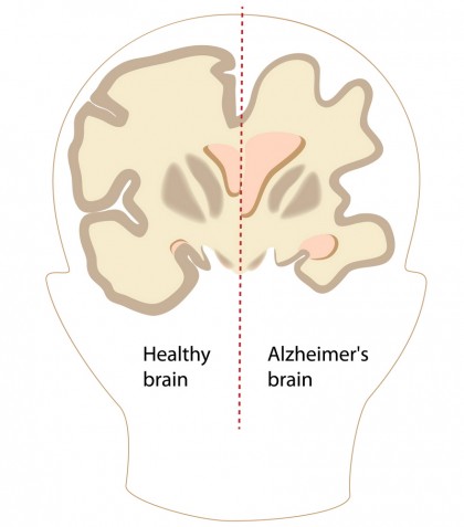 Boala Alzheimer: cauzele progresului afecțiunii în creier, depistate folosind date umane