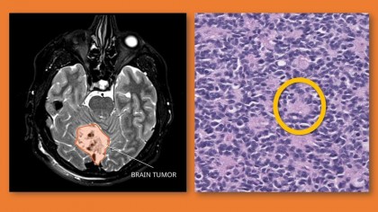 Meduloblastomul, un cancer grav al sistemului nervos, oprit cu ajutorul unei combinații a două terapii vechi