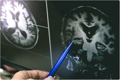 Relația dintre COVID-19 și boala Alzheimer, insuficient studiată până în prezent