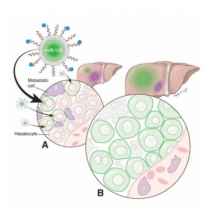 Prevenirea metastazelor la ficat, folosind un medicament nanoterapeutic