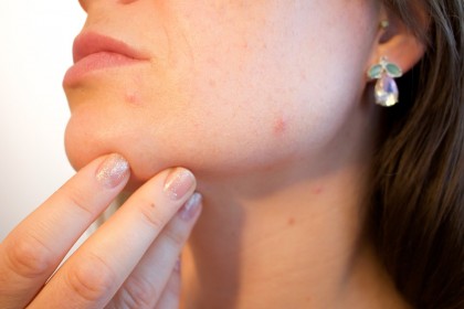 Lactobacilii, folosiți cu succes pentru tratarea leziunilor de acnee