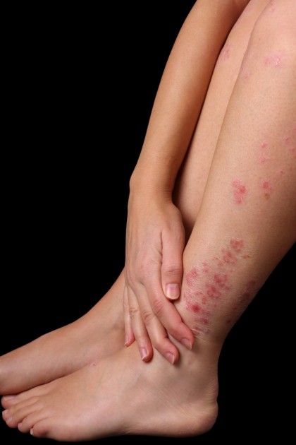 Cum gestionăm dermatita atopică?