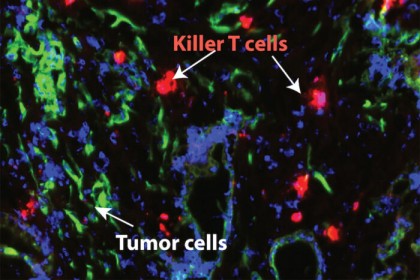 Un inhibator proteic ar putea face cancerul pancreatic susceptibil la terapiile clasice, îmbunătățind supraviețuirea pacienților