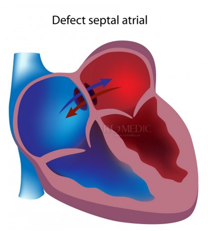 Defectul septal atrial (DSA)