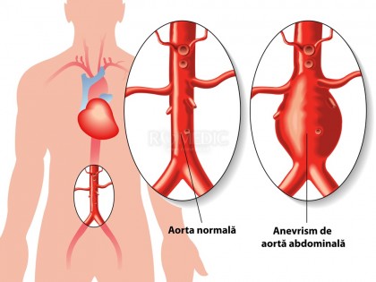 Anevrismele aortei abdominale