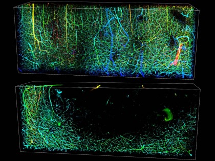 Tratamentul cu gabapentină poate îmbunătăți recuperarea neuromotorie după un accident vascular cerebral