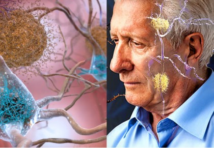 Ce rol joacă proteina tau în boala Alzheimer?