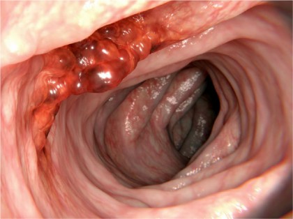 Majoritatea cancerelor intestinale sunt diagnosticate în faze avansate, în afara programelor tradiționale de screening