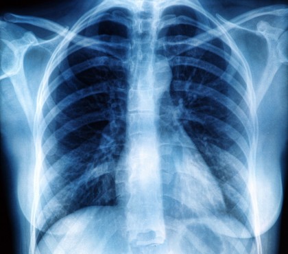 Tratarea cancerului bronho-pulmonar fără celule mici atunci când radioterapia eșuează