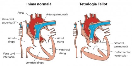 Tetralogia Fallot