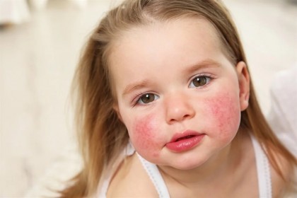 Poluanții din mediul exterior, în special cei atmosferici, pot crește riscul de alergii alimentare la copii