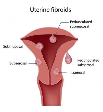 Substanțe chimice regăsite în produse comune de consum pot crește riscul de fibrom uterin