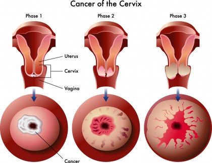 Incidența cancerului de col în rândul femeilor tinere, în creștere în ultimii 10 ani