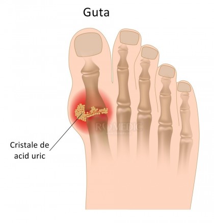 Sindromul metabolic crește de patru ori riscul de gută