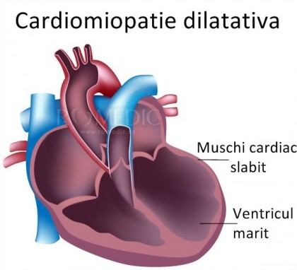 Cardiomiopatia dilatativa idiopatica