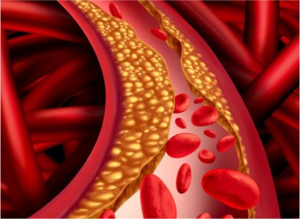 Nivelul plasmatic al acizilor grași neesterificați corelează cu boala arterială periferică