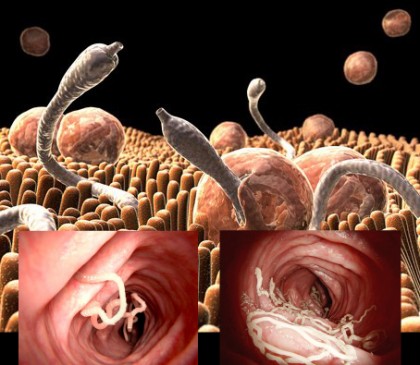 Viermii intestinali - tratament, cauze, simptome, diagnostic