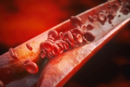 Un nou studiu susține conceptul potrivit căruia ateroscleroza este o boală autoimună a celulelor T care vizează peretele arterial
