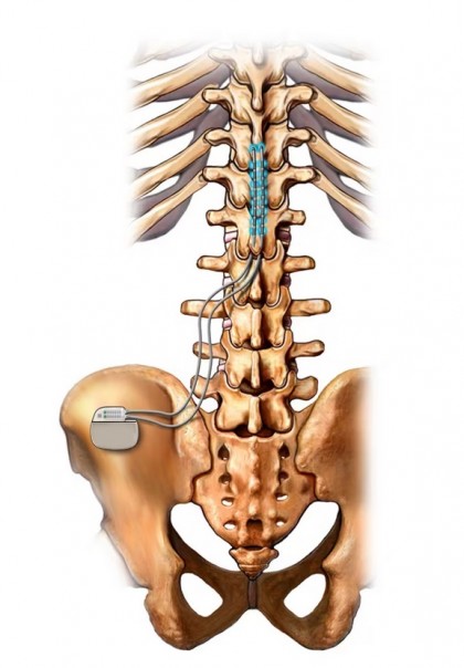 Stimularea măduvei spinării ar putea să ofere doar beneficii reduse sau pe termen scurt pacienților cu dureri cronice de spate