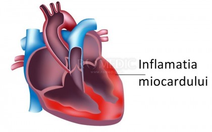Miocardita virala