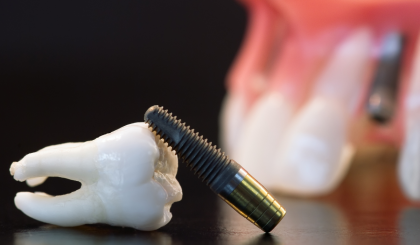 Implanturile dentare și fumatul