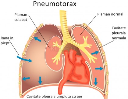 Pneumotoraxul spontan - experiența pacientului
