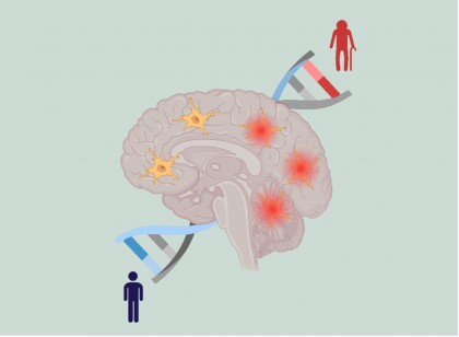 Ce agravează și ce ameliorează scleroza multiplă (studiu)
