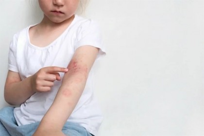 Dermatita atopică la copii și adolescenți - o revizuire a tratamentelor standard și ale noilor terapii