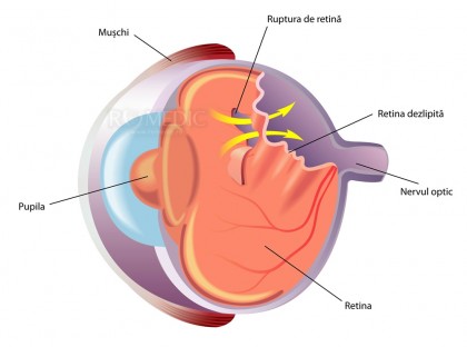 Dezlipirea de retina