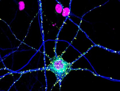 Descoperirea interacţiunii între două proteine ar putea duce la noi tratamente pentru schizofrenie