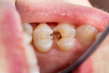 Sigilarea dentară și fluorizările sunt eficiente în reducerea riscului de apariție a cariilor la copii și adolescenți