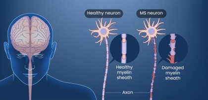 Noi progrese în cercetare în domeniul tratamentului sclerozei multiple