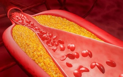 Studiu global pune accent pe identificarea din timp a hipercolesterolemiei familiale