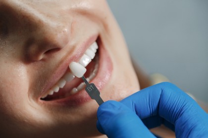 Când sunt recomandate fațetele dentare și cum se aplică