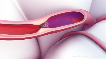 Adăugarea unui anticoagulant la medicația trombolitică în tratamentul accidentelor vasculare cerebrale ischemice