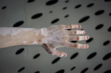 Rolul dietei în tratamentul vitiligo (o revizuire sistematică a factorilor dietetici și a intervențiilor nutriționale)