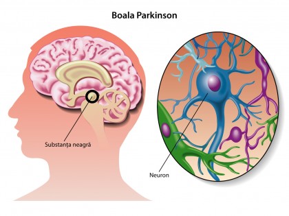 Prasinezumab încetinește progresia motorie în stadiul incipient al bolii Parkinson cu progresie rapidă