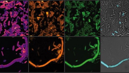 Medicament pentru Parkinson modifică în rău microbiomul intestinal din cauza deficienței de fier