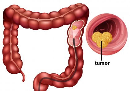 Când se administrează Celecoxib în cancer de colon