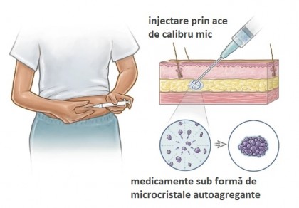 Implant contraceptiv nou cu acțiune prelungită poate fi administrat prin ace minuscule